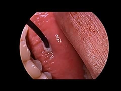 खर्राटे उपचार रेडियो फ्रीक्वेंसी प्लाज्मा जनरेटर मल्टी फंक्शन जांच के साथ