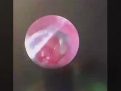 ButterFly ENT सर्जरी उपकरण ENT जांच