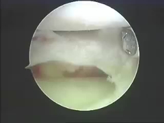 रीढ़ और जोड़ों के लिए इलेक्ट्रोसर्जिकल उपकरण एब्लेशन सिस्टम एब्लेशन उत्पाद