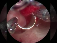 कूल टेक्नोलॉजी प्लाज्मा सर्जरी इलेक्ट्रोड यूरोलॉजी बीपीएच प्रक्रियाओं के लिए