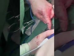 क्लिनिक हेपेटोलॉजी प्रोब PLA408 ओपन सर्जरी के लिए